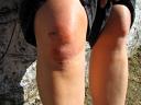 My knee's so swollen it looks like I have two kneecaps